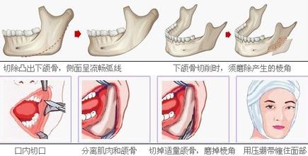 关于下颌角截骨手术术前准备