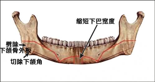 下颌角截骨术中意外出血与术后血肿形成