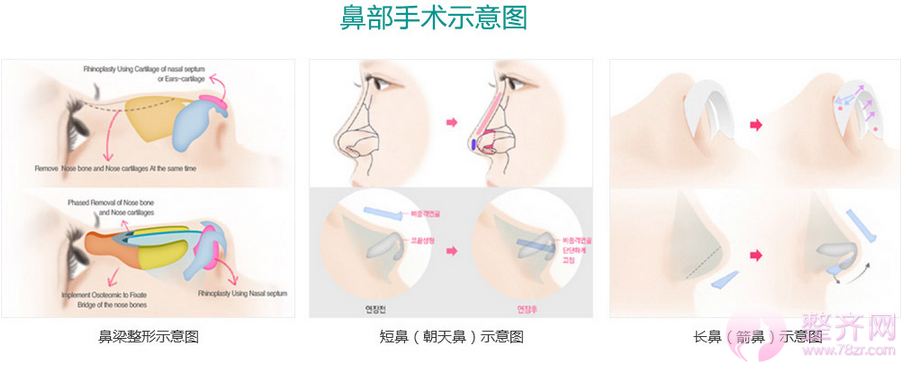 广州紫馨金孝宪隆鼻怎么样？案例图？