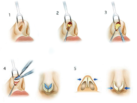 自体耳软骨垫鼻尖的原理和过程