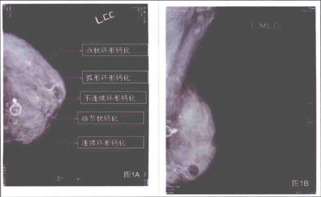 自体脂肪移植隆胸后的影像是如何表现的？