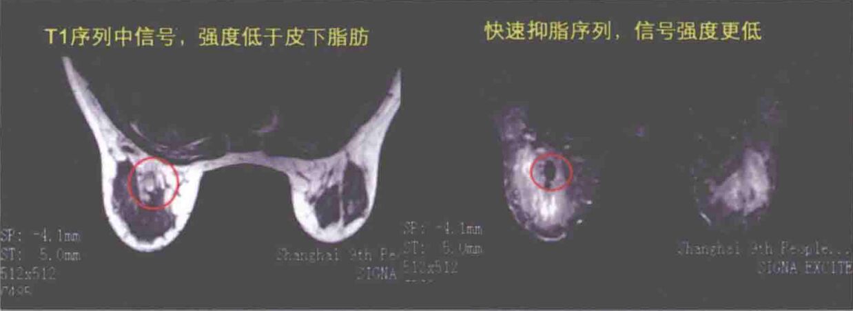 自体脂肪移植隆胸后的影像是如何表现的？