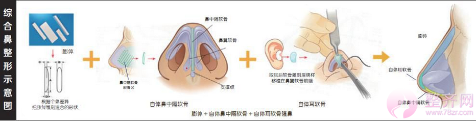 什么是隆鼻整形？