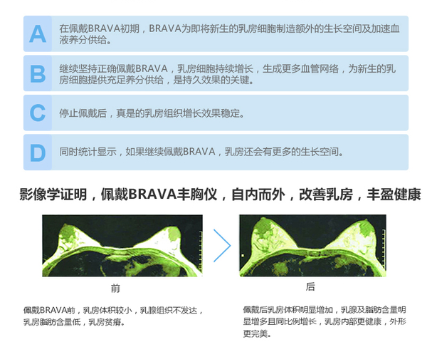 BRAVA非手术丰胸方法