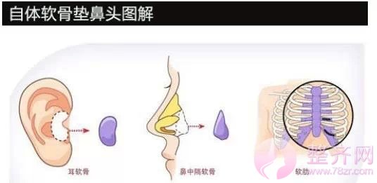 隆鼻有哪几种方法呢？