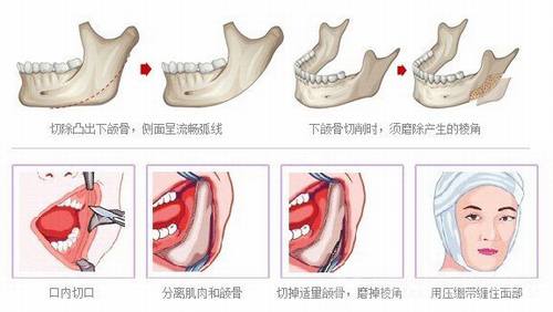 下颌角手术是怎么样的？好不好？