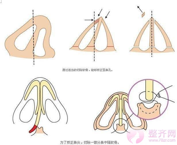 自体软骨隆鼻多方面解析