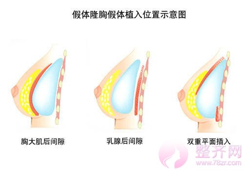 假体隆胸多方面解析