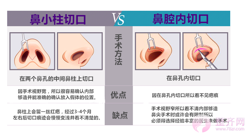 多方面解析隆鼻术