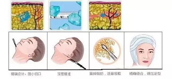 脸大打注射瘦脸就够了？“对阵下药”才有！