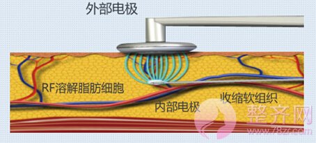 吸脂仪器及手法的问题！