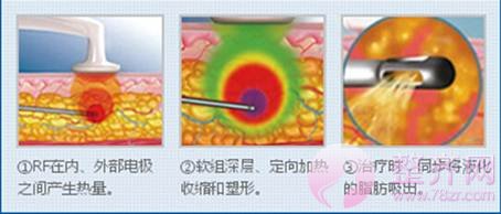 吸脂仪器及手法的问题！