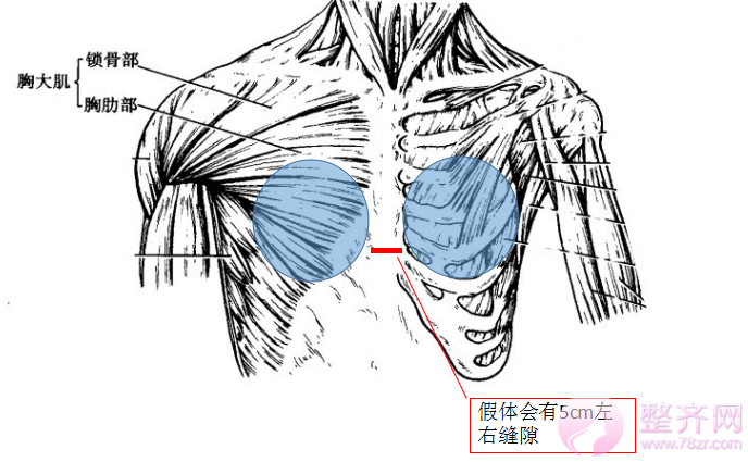 假体结合自体脂肪隆胸整形趋势