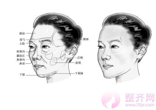 全脸脂肪填充消肿时间和注意事项