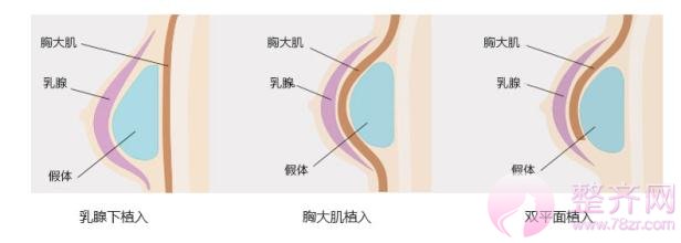 隆胸常用方法解析