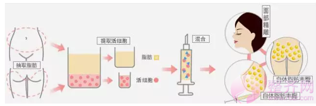 自体脂肪移植为何如此受欢迎？