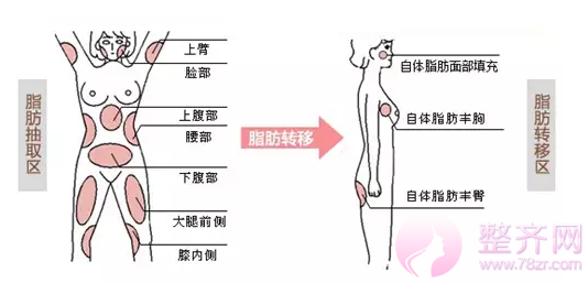 自体脂肪移植为何如此受欢迎？