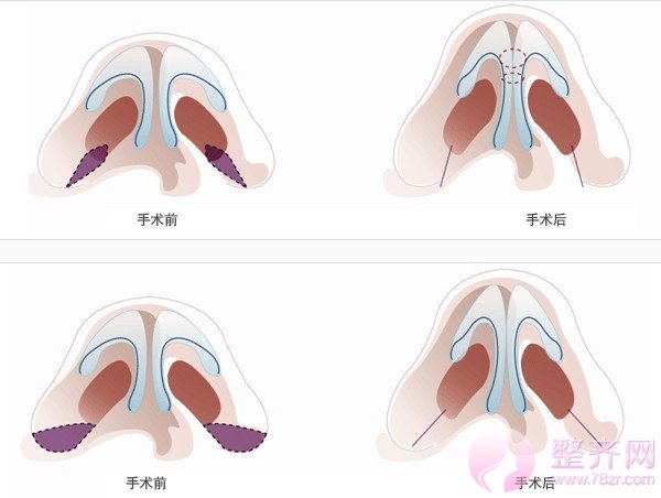 【一个漂亮的鼻子有多重要】