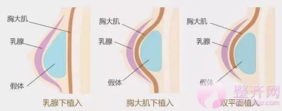 假体隆胸手感硬还不能剧烈运动？No！