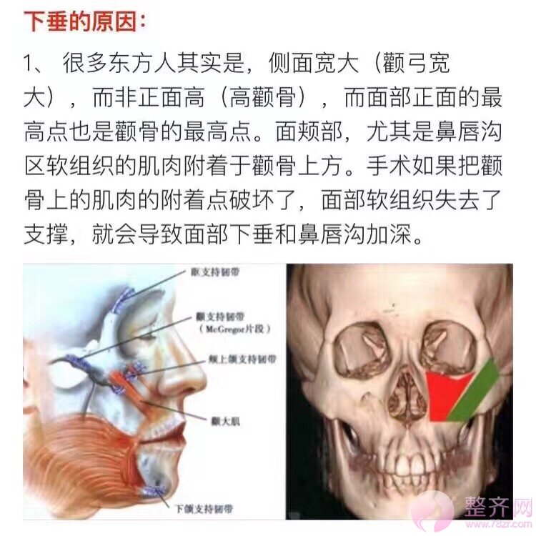 磨颧骨到底会不会下垂？