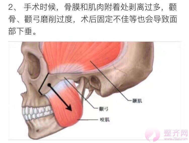 磨颧骨到底会不会下垂？