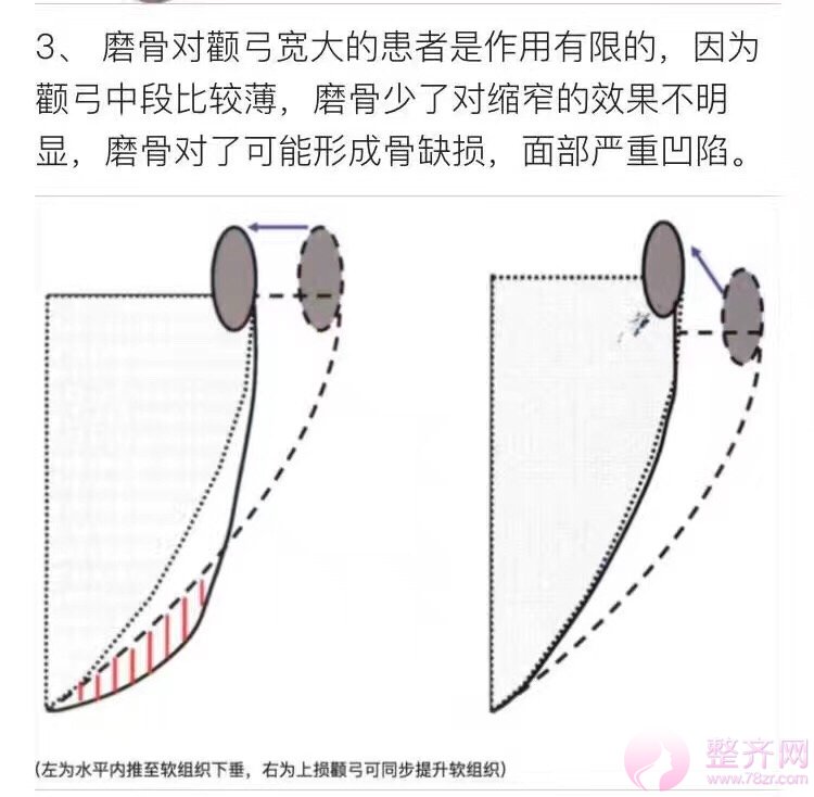 磨颧骨到底会不会下垂？