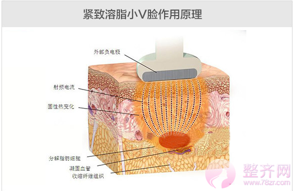 紧致溶脂小V脸果