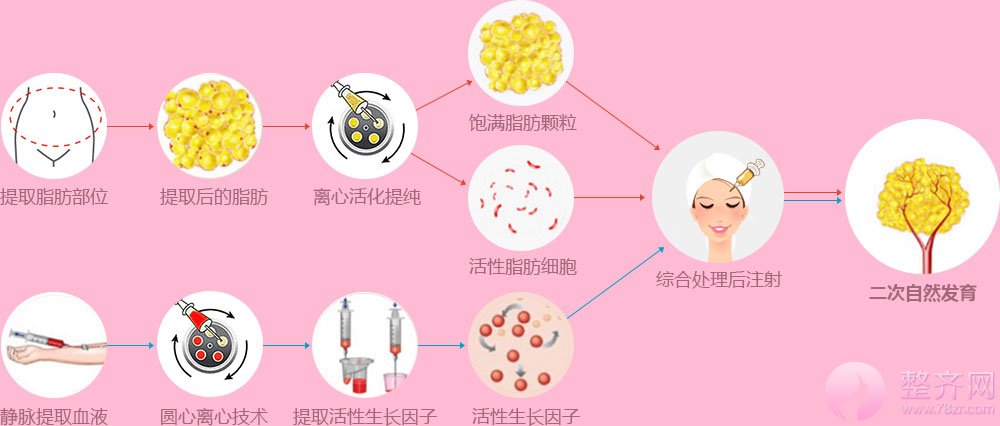 自体脂肪面部填充一次解决肥胖和显老