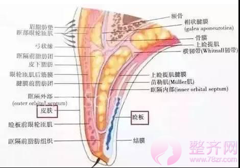 什么是埋线双眼皮