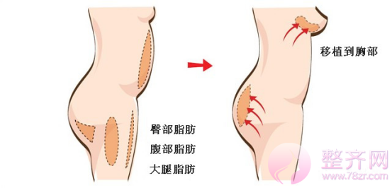 丰胸又瘦腰，自体脂肪隆胸到底好不好？