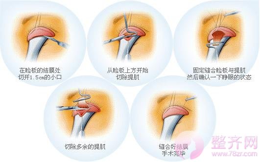 眼睑下垂矫正术，凸显眼部魅力