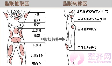 脂肪填充让你拥有童颜！