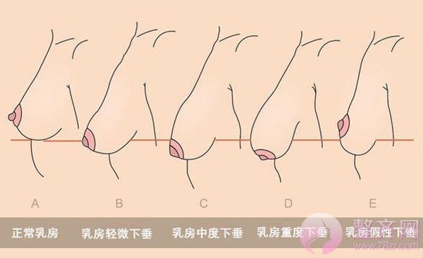 乳房下垂到底有什么影响