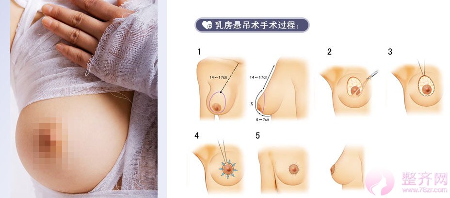 乳房下垂到底有什么影响