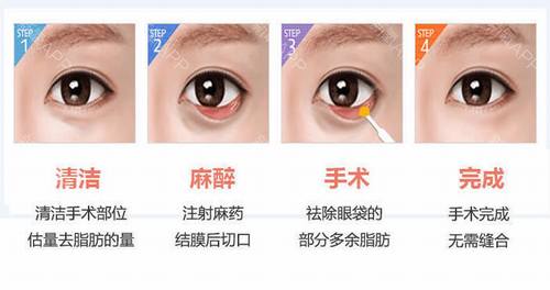 内切祛眼袋好不好？多少钱？