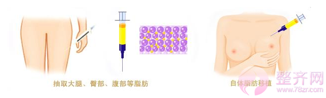 活性脂肪编码丰胸术