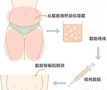 自体脂肪隆胸手术主要并发症、后遗症解析