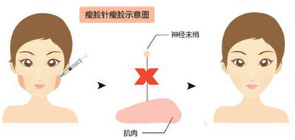 上海九院打注射瘦脸让脸变的更漂亮