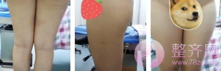 大腿吸脂3个月案例