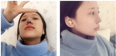 鼻骨矫正是怎么样的？多少钱？