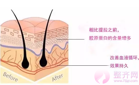 如何改善皮肤松弛下垂？