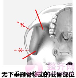 什么是无下垂颧骨移动术？