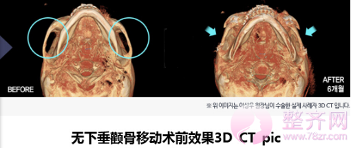 什么是无下垂颧骨移动术？