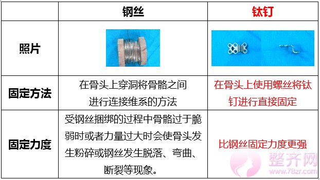 无下垂颧骨移动术3大亮点