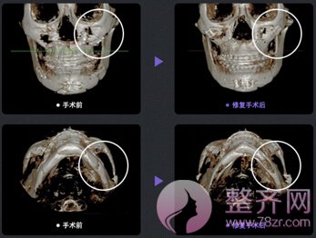 颧骨移动术手术方案