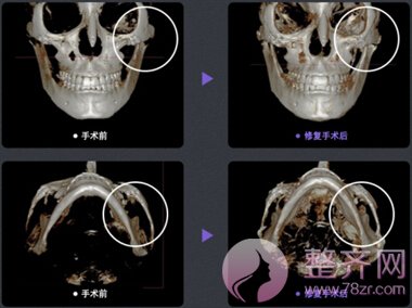 颧骨移动术手术方案