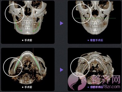 颧骨移动术手术方案