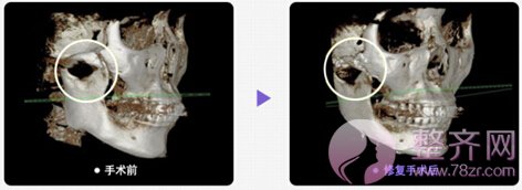 颧骨移动术手术方案