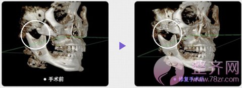 颧骨移动术手术方案