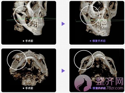 颧骨移动术手术方案